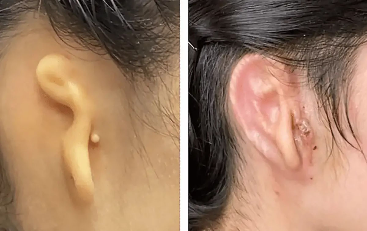 Se llevó a cabo el primer trasplante de oreja hecha con células humanas mediante impresión 3D