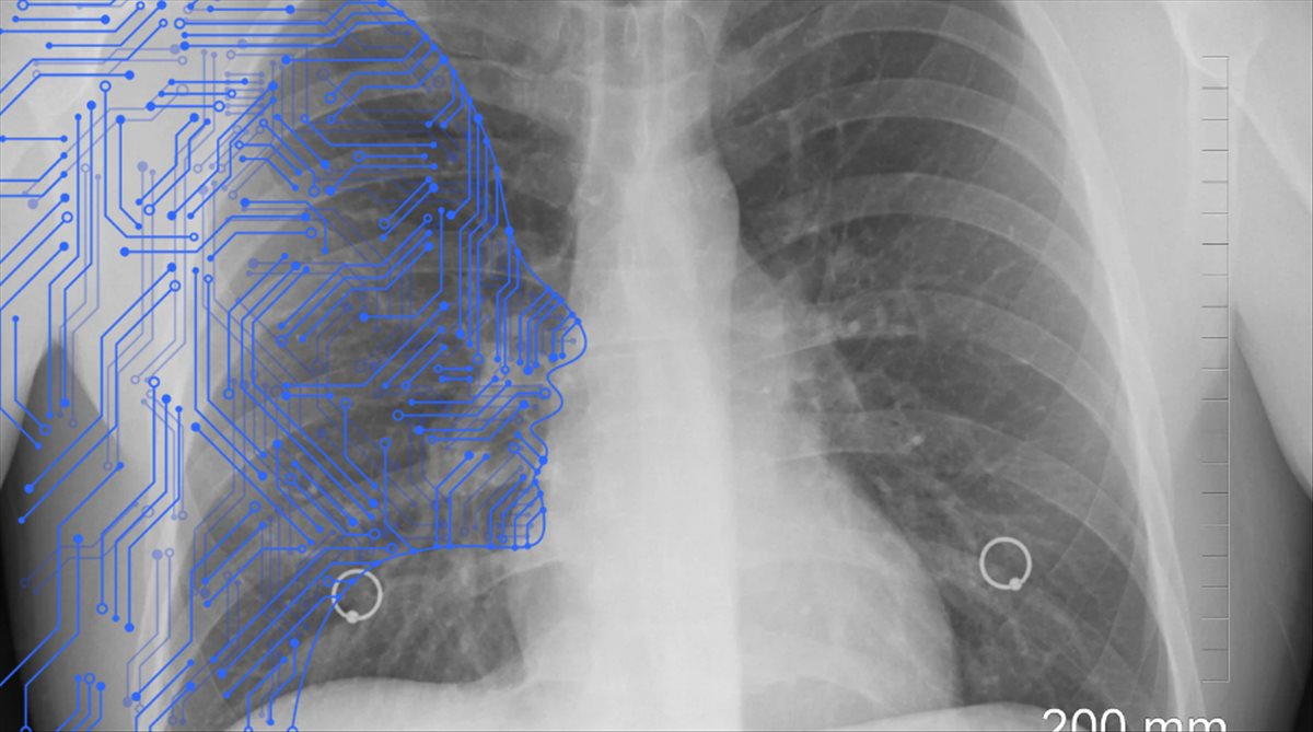 Detección de riesgo de cáncer de pulmón usando Inteligencia Artificial