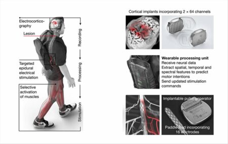 implantes cerebro columna