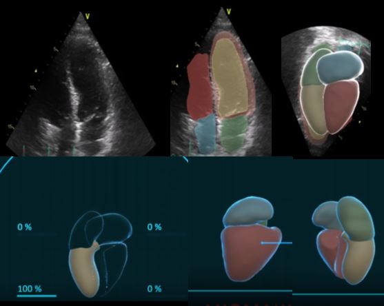 Proceso de escaneado de corazón, de 2D a 3D